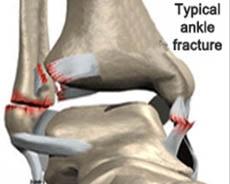 ankle cartilage surgery in india
