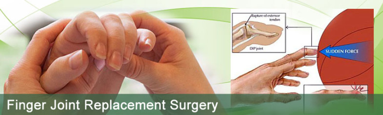 Finger Joint Replacement Surgery In India What To Expect 