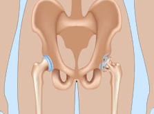 arthroplastie de la hanche en Inde